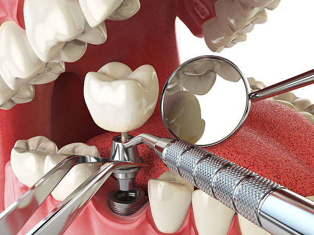 Best Emergency Gum Treatment in Pulaski, NY